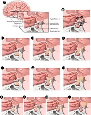 An update on multimodal management of craniopharyngioma in children